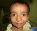 1st Post operation picture