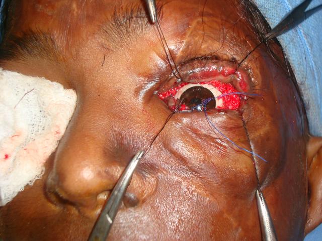 Post burn contracture post op1