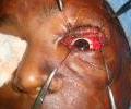 Post burn contracture post op1