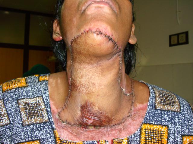 2nd case Postop picture