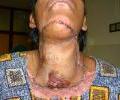 2nd case Postop picture