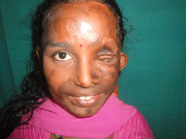 Post burn contracture