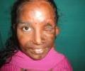 Post burn contracture