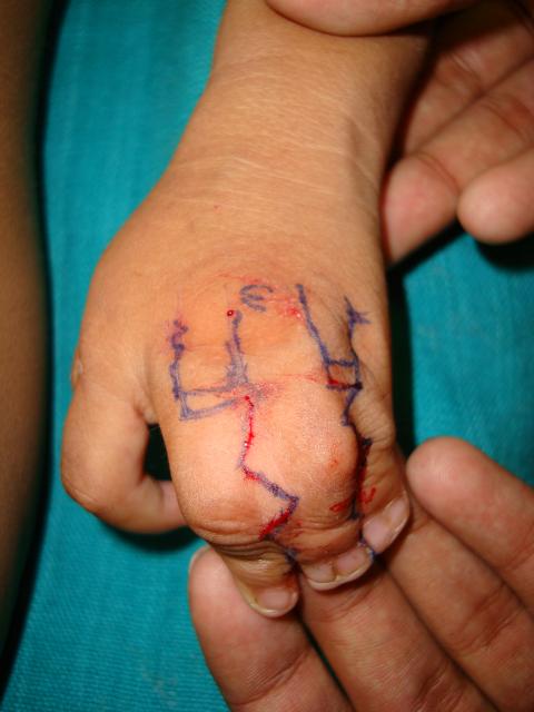 2. Pre Op marking