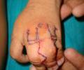 2. Pre Op marking