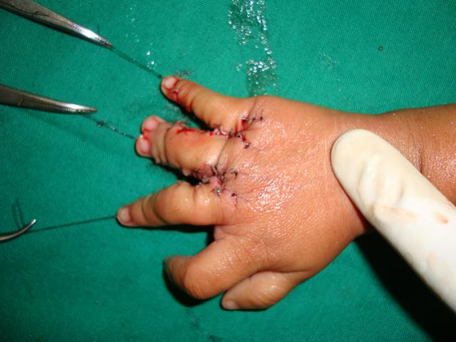3. Intraop