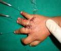 3. Intraop