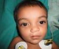 Cleft lip 