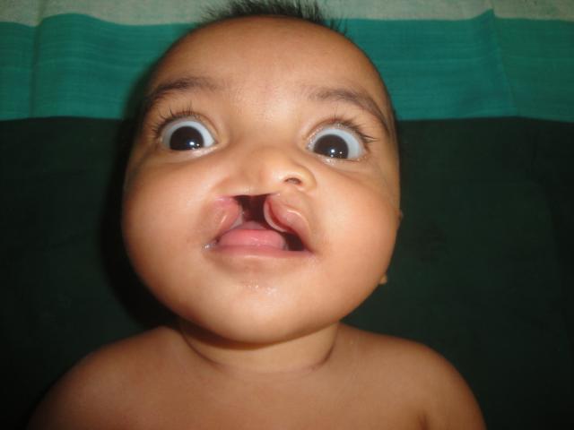 Cleft lip 