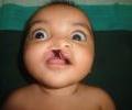 Cleft lip 