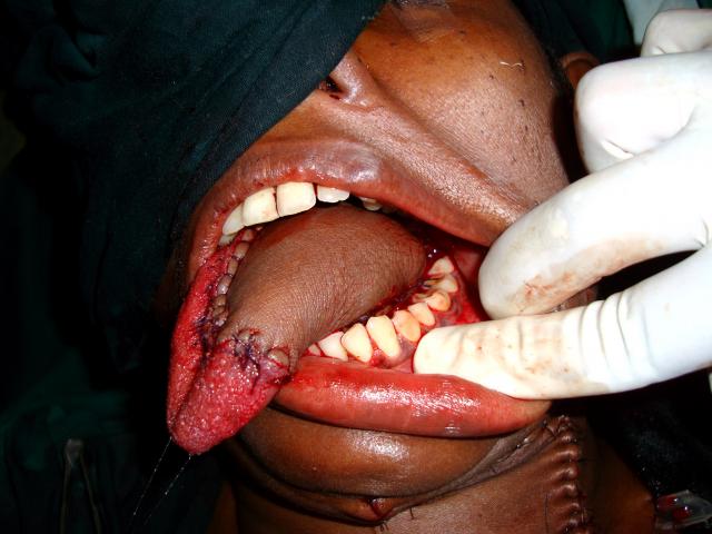 4th Post op picture