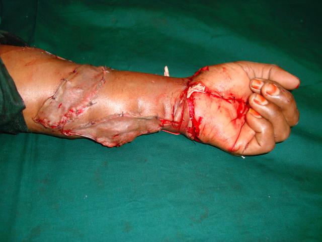 3rd case Post operation