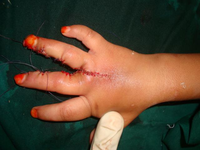 4. Post Op 