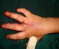 4. Post Op 
