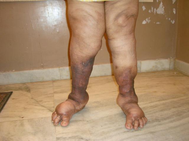 1st case Pre operation