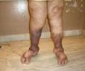 1st case Pre operation