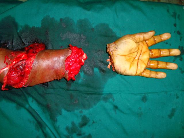 3rd case Pre operation