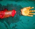 3rd case Pre operation