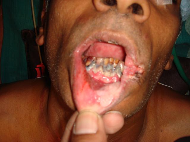2nd picture Pre operation