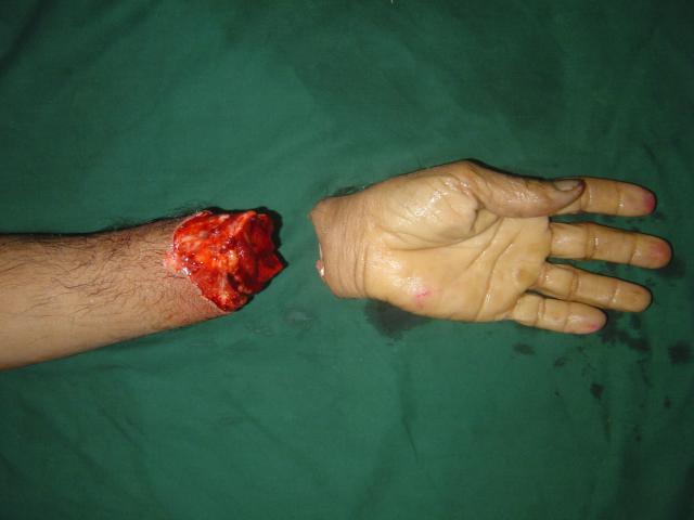 2nd case Pre operation
