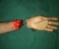 2nd case Pre operation